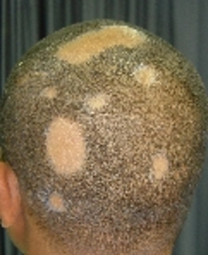 alopecia areáta hajgyógyászat